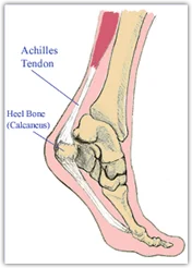 Achilles Tendonitis
